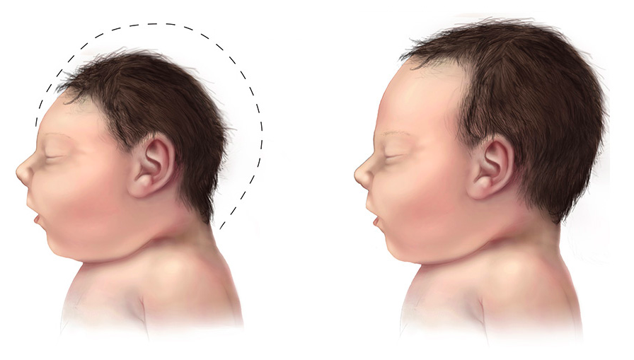 A baby with microcephaly (left) compared to a baby with a typical head size